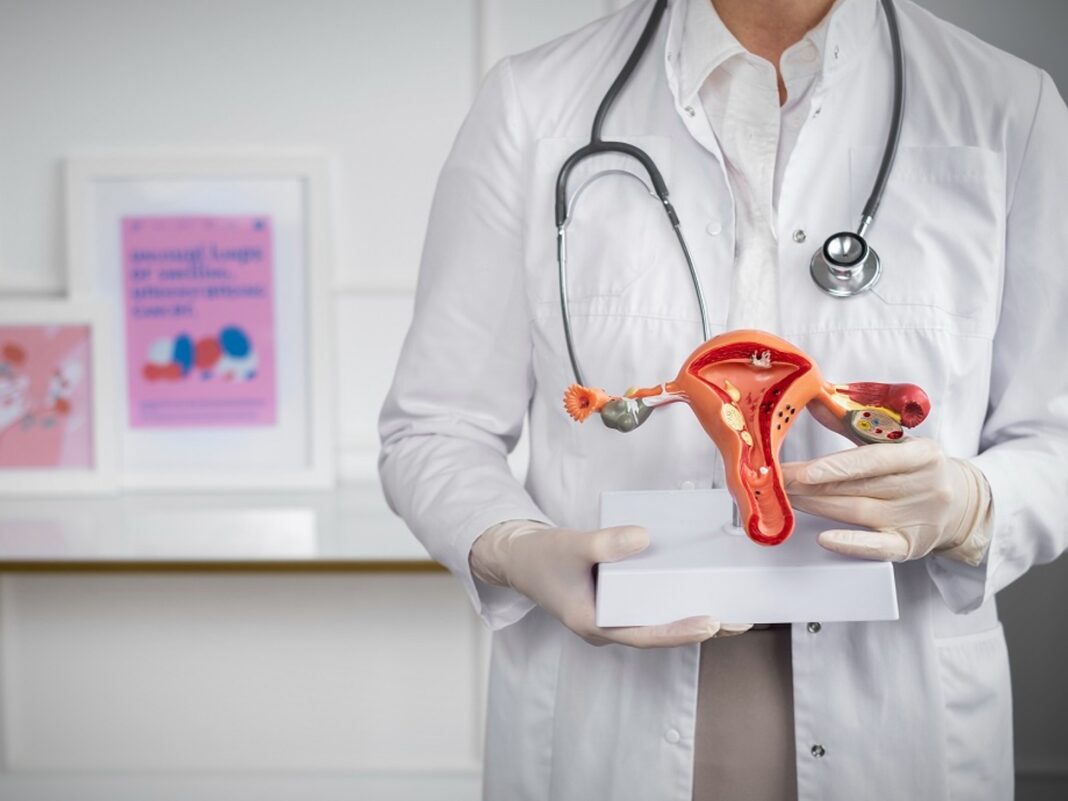 cáncer de ovario