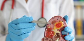 cáncer de riñon