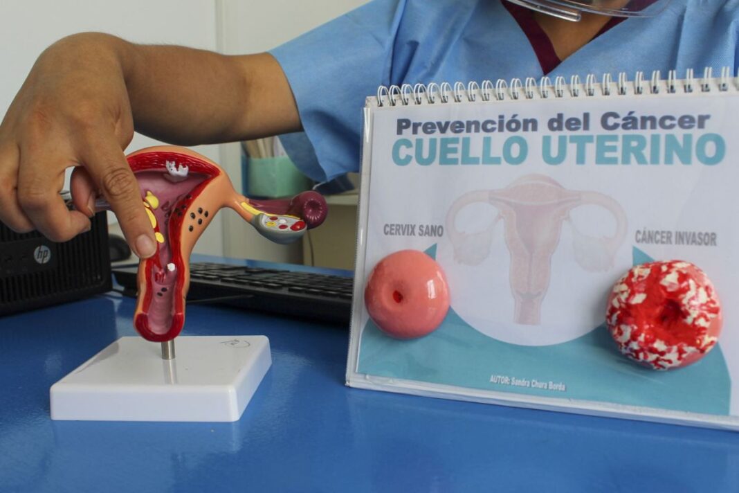 Cáncer de cuello uterino